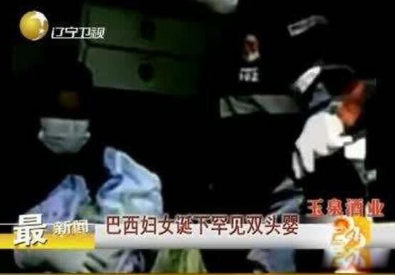 双头婴儿长大了吗 双头婴儿现在怎么样了?生活幸福