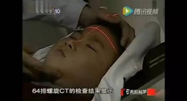 僵尸男孩为什么死了 重庆僵尸男孩真实事件得了什么病