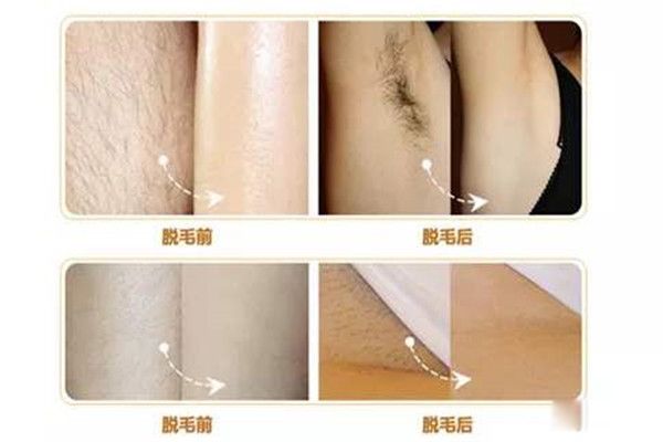 激光脱毛可以永久去除吗 激光脱毛后悔一辈子