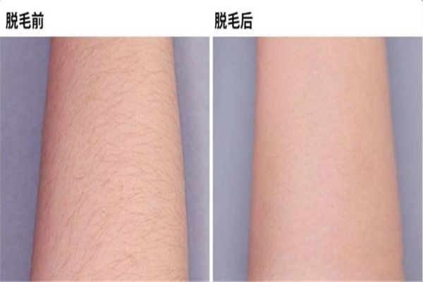 激光脱毛可以永久去除吗 激光脱毛后悔一辈子