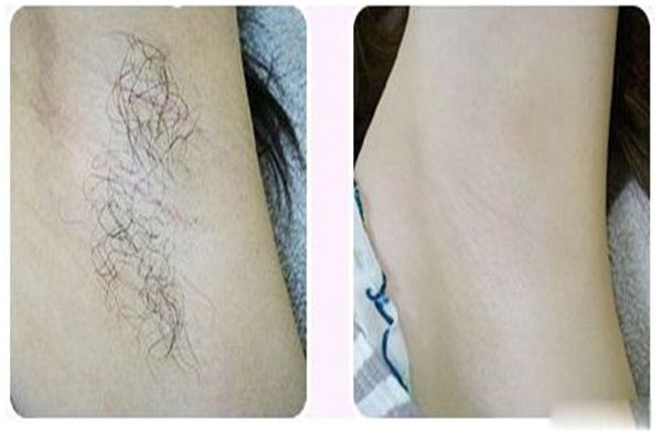 激光脱毛可以永久去除吗 激光脱毛后悔一辈子