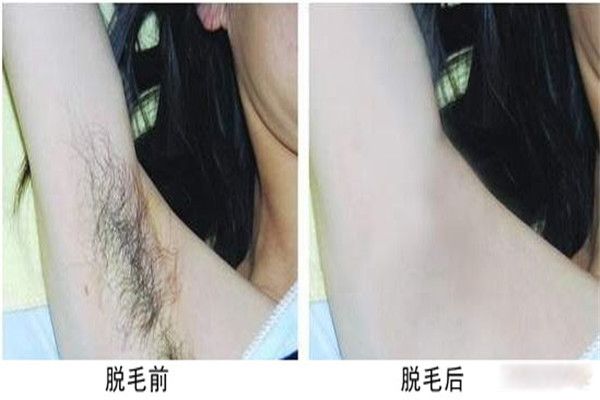 激光脱毛可以永久去除吗 激光脱毛后悔一辈子