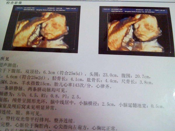 产妇生出无眼娃 生下来没眼睛的小孩怎么回事啊
