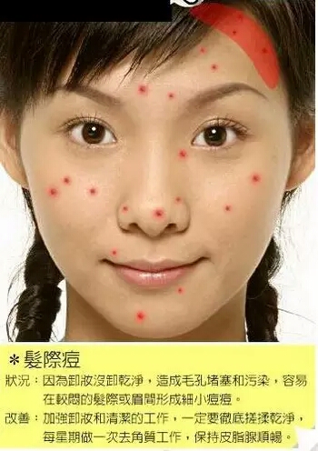 长痘痘的位置图解 长痘痘是因为什么原因引起的