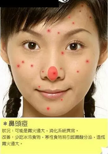 长痘痘的位置图解 长痘痘是因为什么原因引起的