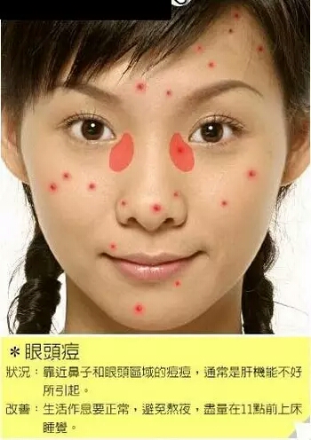 长痘痘的位置图解 长痘痘是因为什么原因引起的