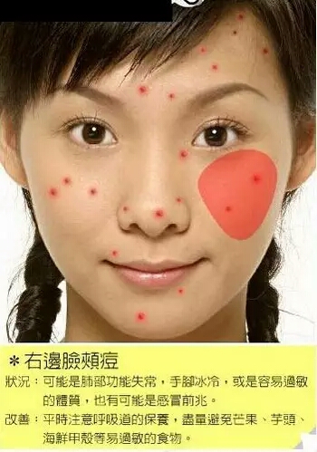 长痘痘的位置图解 长痘痘是因为什么原因引起的