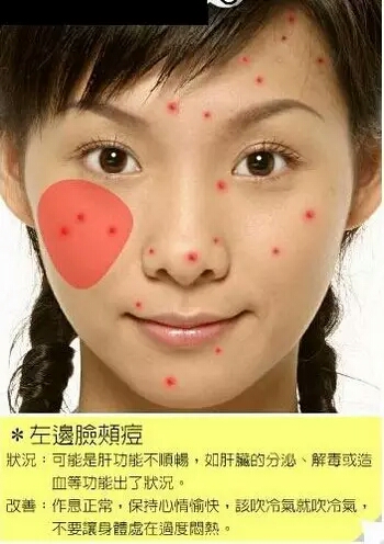 长痘痘的位置图解 长痘痘是因为什么原因引起的