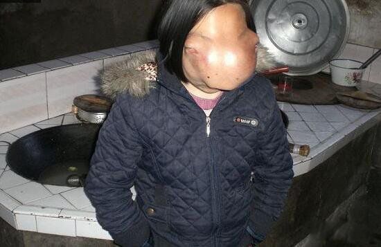 吴晓燕的脸手术后现在的样子 马脸女孩吴小燕怎么样了