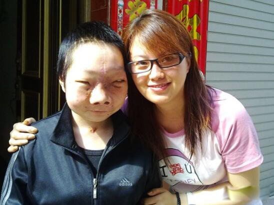 吴晓燕的脸手术后现在的样子 马脸女孩吴小燕怎么样了