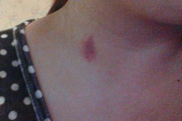 吸草莓对身体有什么危害 吸草莓印会有什么坏处会不会把人吸死