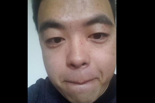 扁平疣早期图片大全 脸上长了这个东西要赶快治疗的