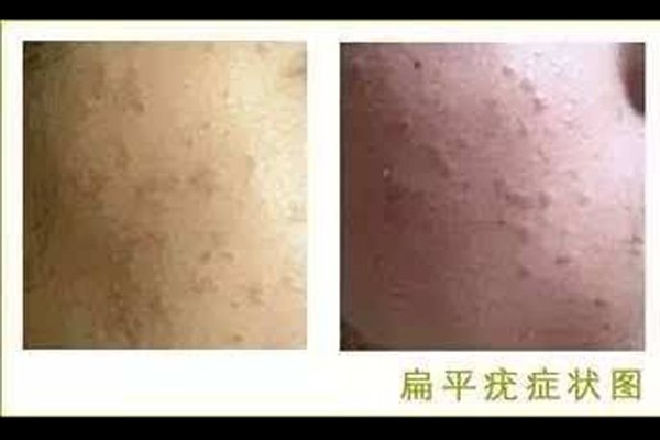 扁平疣早期图片大全 脸上长了这个东西要赶快治疗的