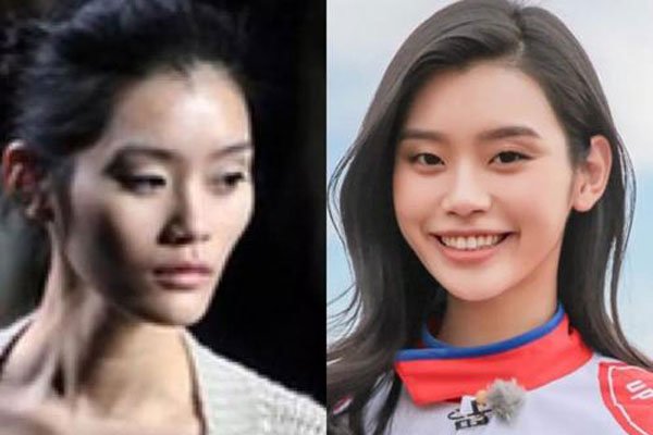 奚梦瑶面部填充整容对比 整容改命一跃嫁入豪门