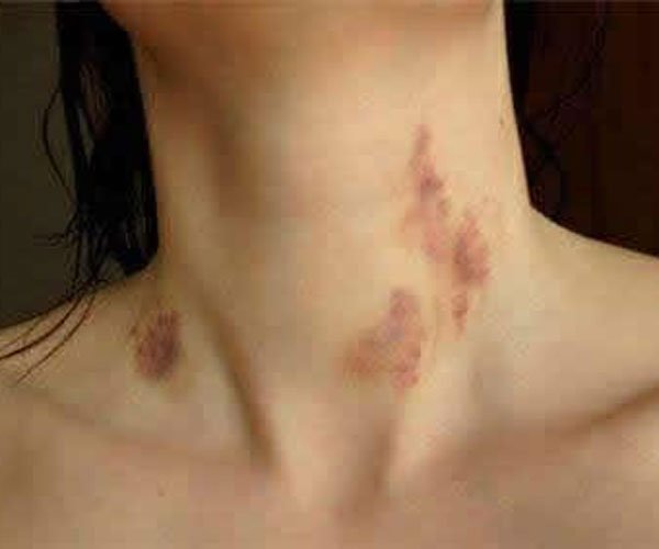 种草莓是什么意思啊 男女种草莓代表睡过了吗