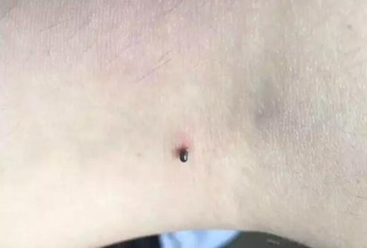 蜱虫咬人伤口辨认图片 死亡率不低:蜱虫咬人后有什么症状,怎么治疗