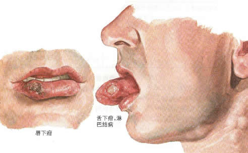 梅毒的初期症状和图片 主要症状和表现怎么引起的