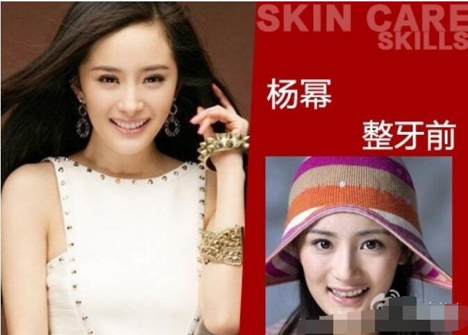 杨幂下牙只有6颗是真的吗 做的烤瓷牙颜值大大提高