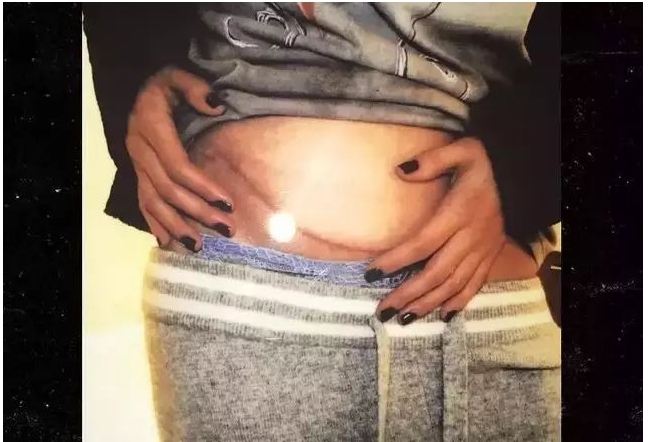 赛琳娜的病能活多久 傻脸妹赛琳娜为什么换肾