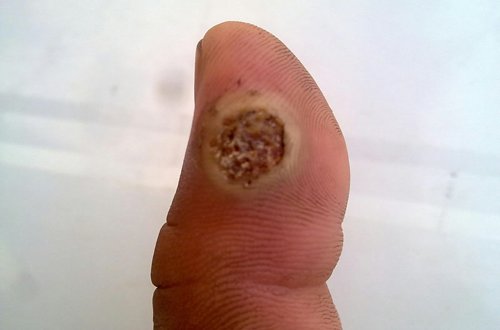 莲蓬乳,空手指,芝麻手是怎么回事 图片渗人是用软件叠加的合成照