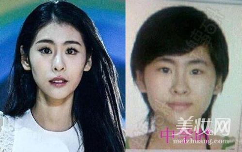 张碧晨整容呀对比前后 一大一小:张碧晨鼻子很奇怪整过容吗