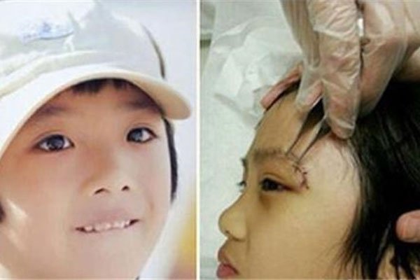 费曼眼睛的事最后怎么处理解决的 带伤录节目:眼角伤谁弄的