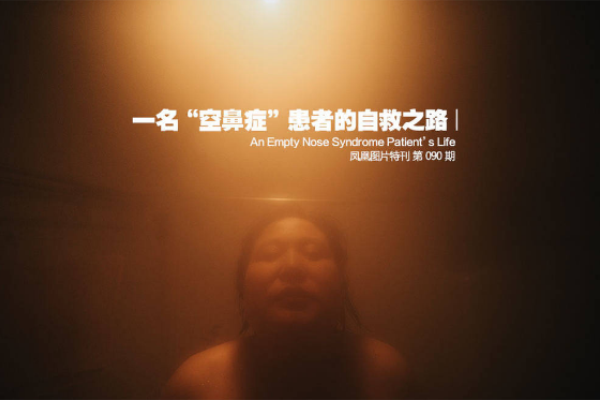 空鼻症患者与正常鼻子图片对比 空鼻症患者痛苦余生无希望