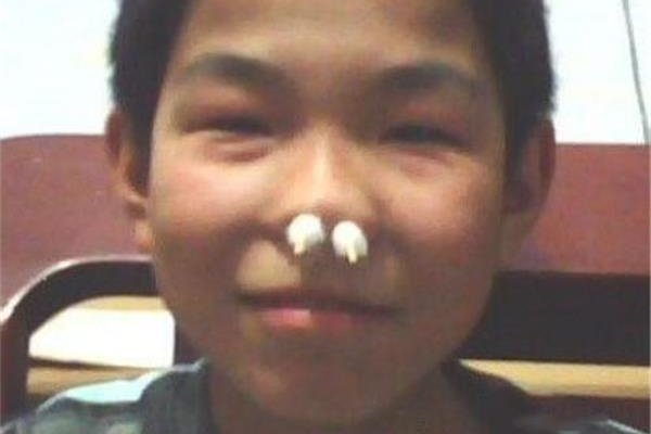 空鼻症患者与正常鼻子图片对比 空鼻症患者痛苦余生无希望