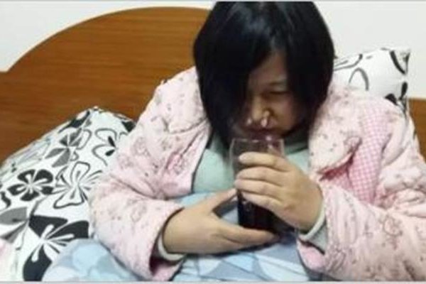 空鼻症患者与正常鼻子图片对比 空鼻症患者痛苦余生无希望