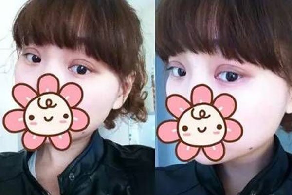 宋慧乔双眼皮是什么类型 能呈现出自然的双眼皮形态