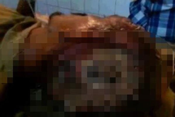 尸虫是什么样子的+病人身上图片 美味小龙虾是二战尸虫吗