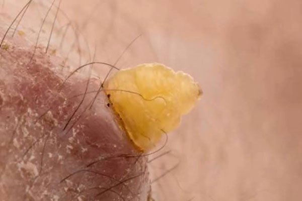 尸虫是什么样子的+病人身上图片 美味小龙虾是二战尸虫吗